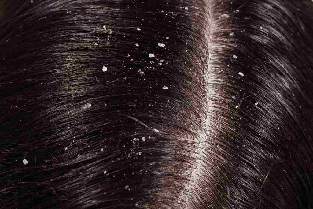 11 Cara Mengatasi Rambut Rontok dan Ketombe, Mudah dan Aman