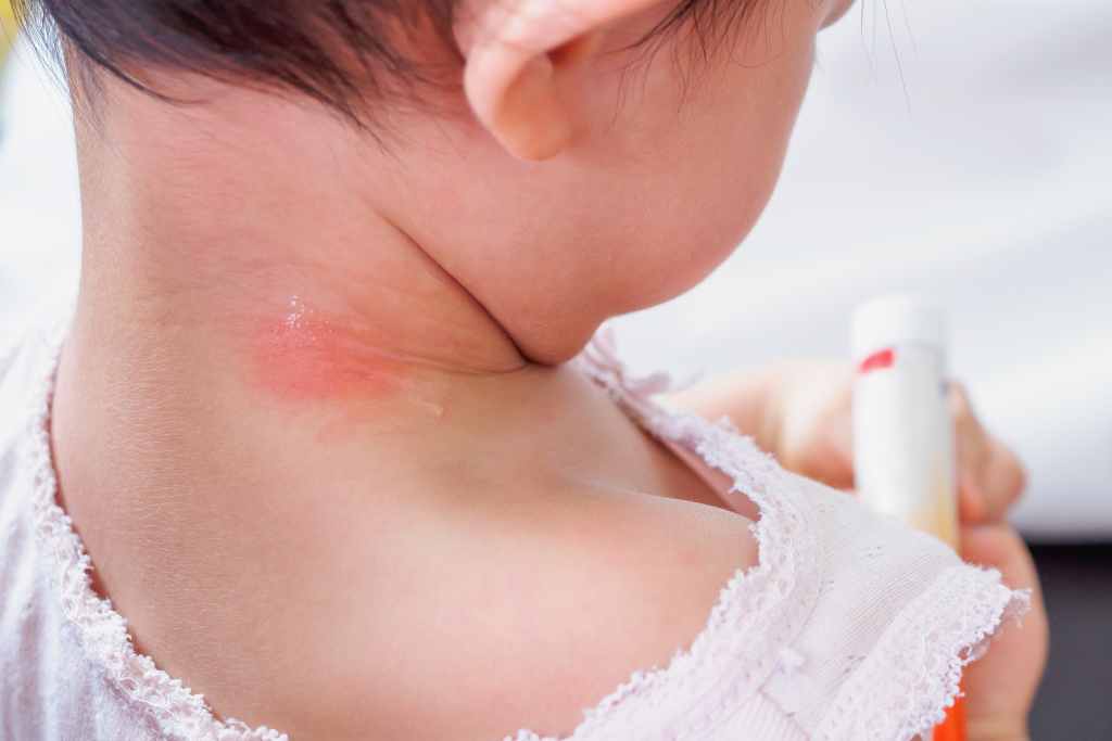 Penyebab dan Cara Mengatasi Leher Bayi Merah serta Lecet