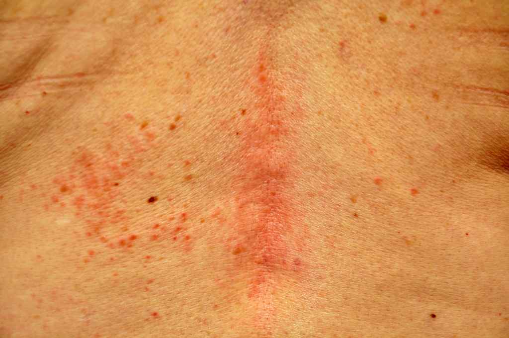 Petechiae: Gejala, Penyebab, Diagnosis dan Pengobatan