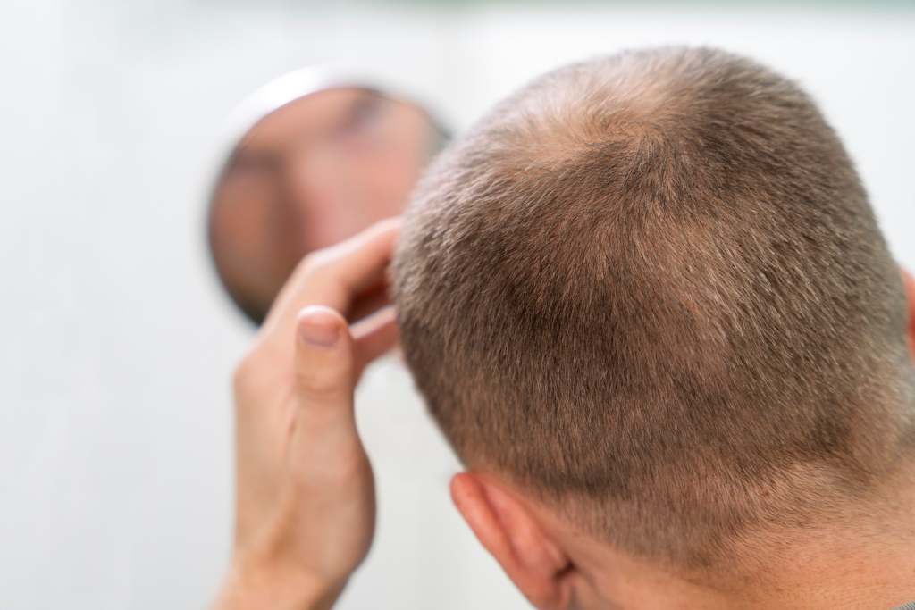 10 Cara Menumbuhkan Rambut Pitak, dari yang Alami hingga Medis