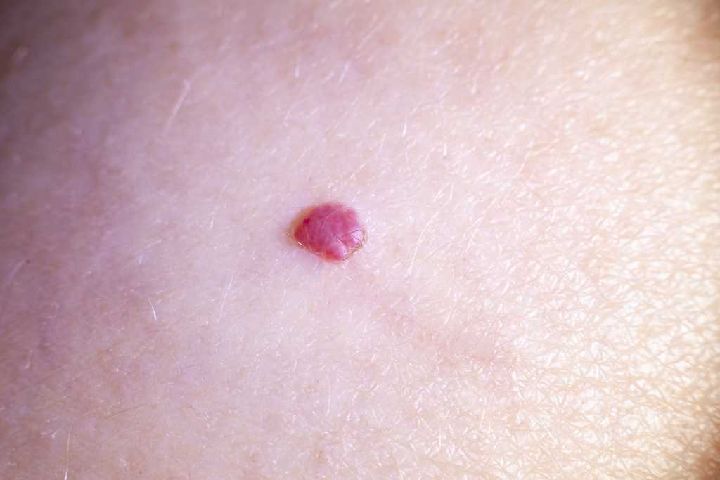 Cherry Angioma: Gejala, Penyebab, Diagnosis, dan Penanganan