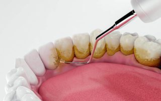 Bahaya Karang Gigi yang Tidak Dibersihkan dan Cara Mudah Mencegahnya