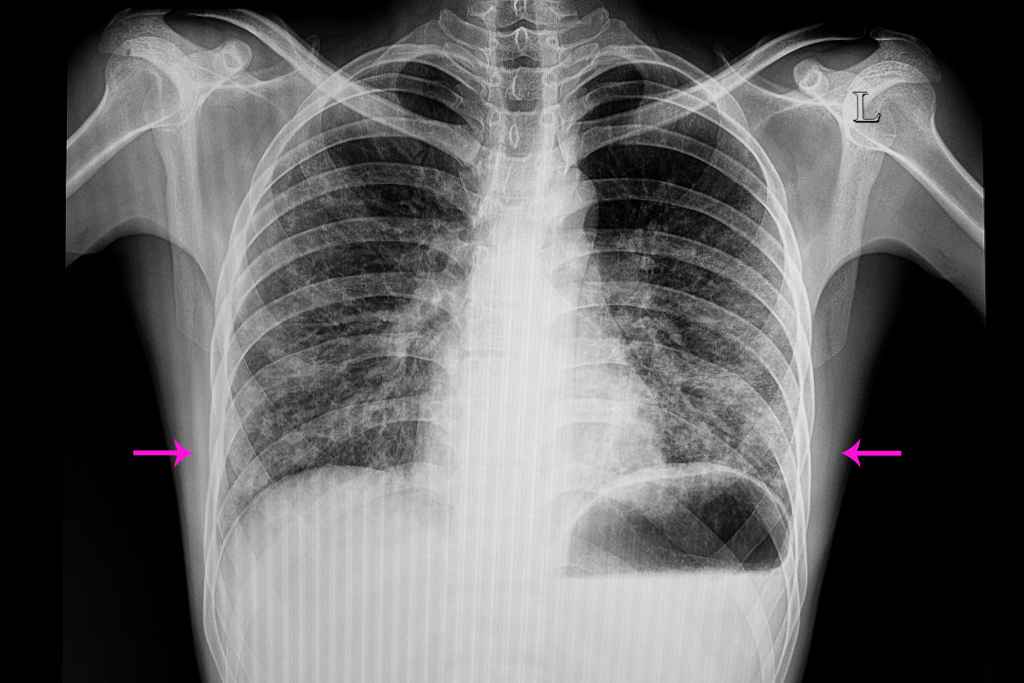 Beda Pneumonia Dan Pneumothorax Yang Perlu Diketahui