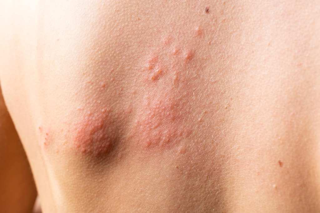 herpes zoster doktersehat