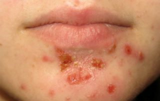 Impetigo pada Anak, Kenali Penyebab hingga Cara Mengobatinya