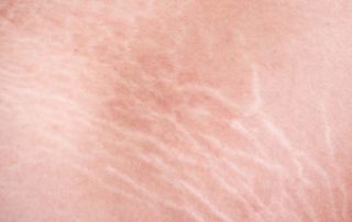 Stretch Mark pada Remaja, Ini Penyebab dan Cara Mengatasinya