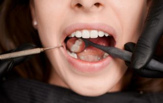 11 Cara Merawat Gigi Berlubang agar Tidak Semakin Parah