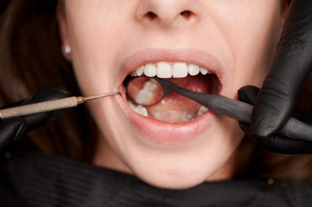 11 Cara Merawat Gigi Berlubang agar Tidak Semakin Parah