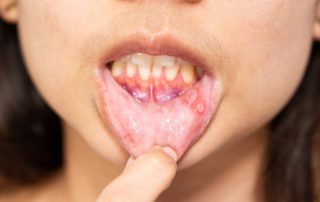 Penyebab Sifilis Berkembang di Mulut dan Cara Mengobatinya