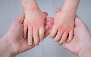 Mengenali Tanda Dermatitis Atopik pada orang Dewasa dan Anak-anak